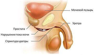 striktura-uretry-1