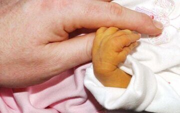 Физиологическая желтуха новорожденных: симптомы и лечение
